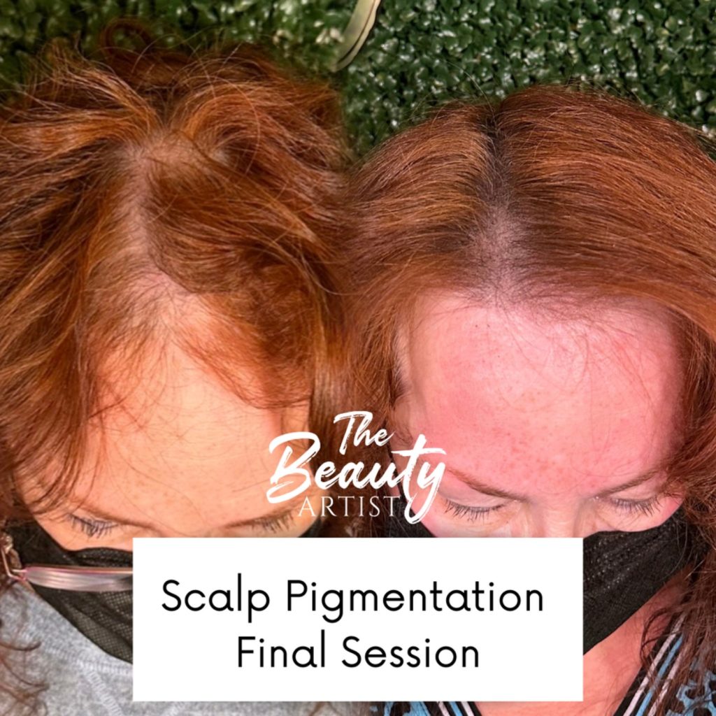 Example of scalp pigmentation final session