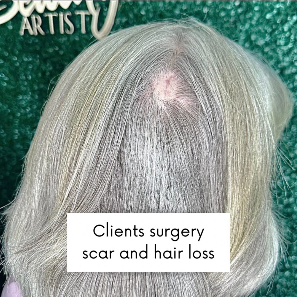 Client's surgery scar and hair loss