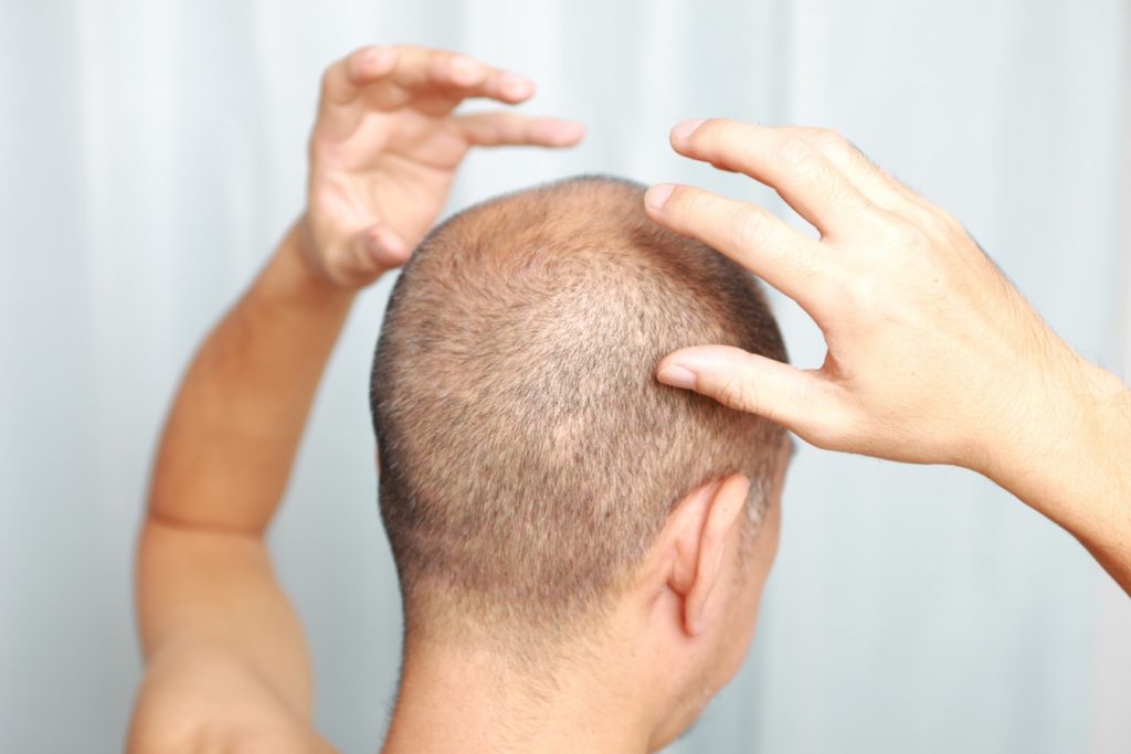 Example of full scalp pigmentation