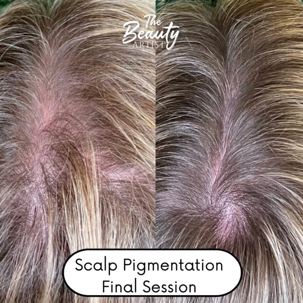 Before and after photo of scalp pigmentation